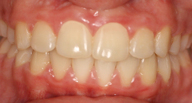 Patient-7-After