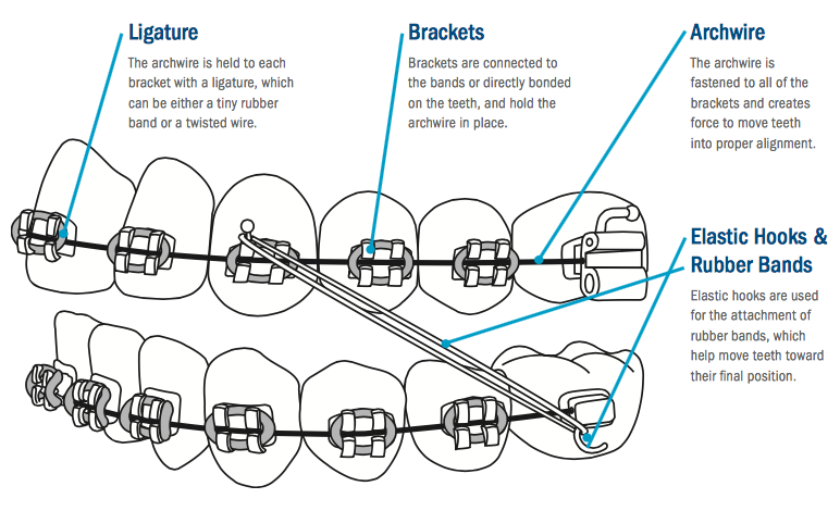 Rubber Bands in Your Mouth: Why You Need to Wear Elastics for Braces